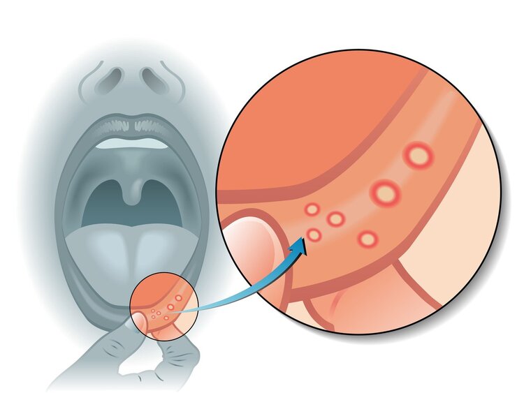 6 đặc điểm của bệnh viêm loét miệng, có thể là ung thư